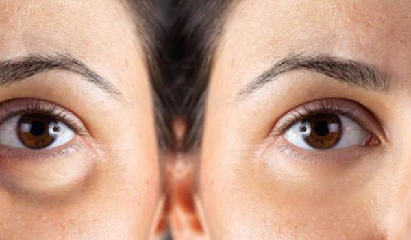 بهترین کرم دور چشم